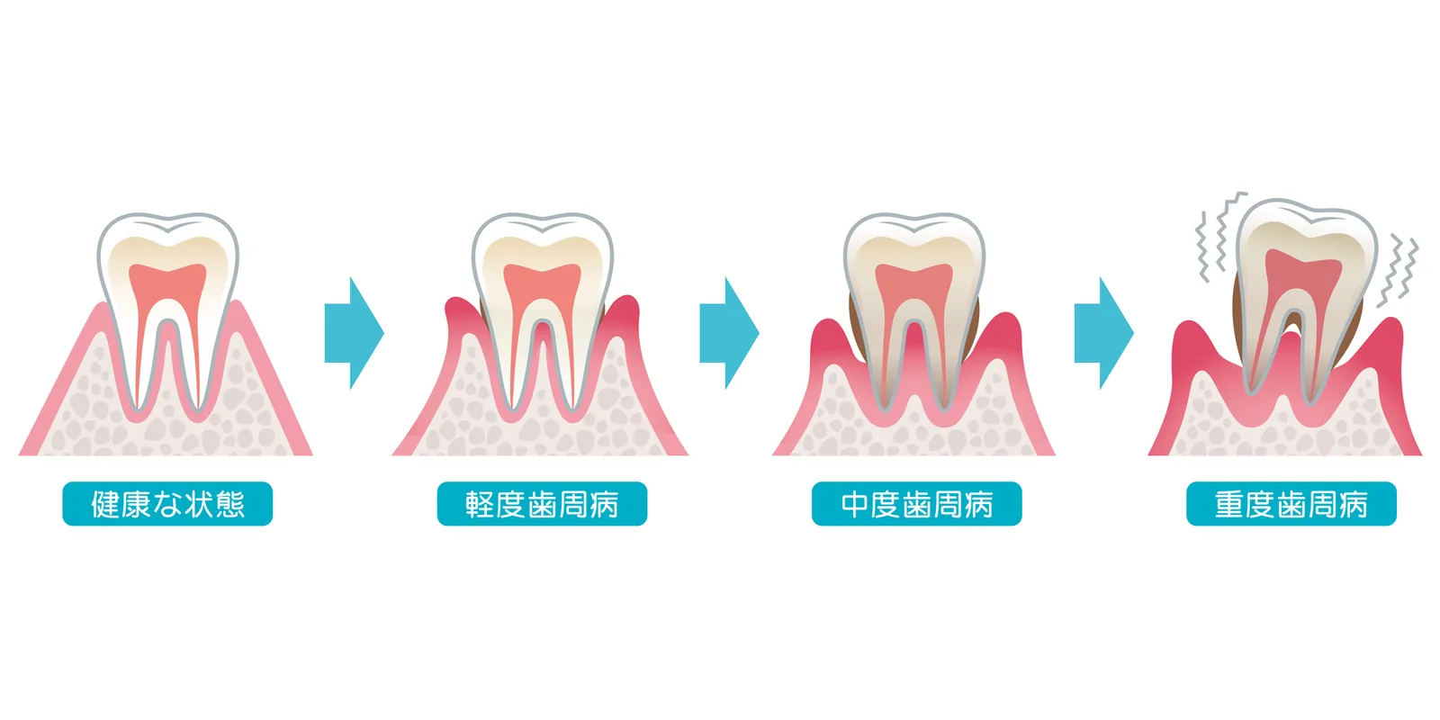 歯周病の進行段階（図解）
